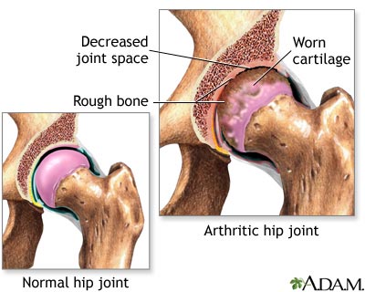 Arthritis Treatment on Treatment Of Arthritis Of The Hip When You Visit The Doctor With